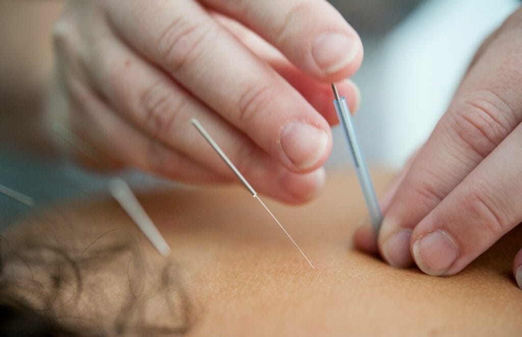 Acupuntura para ansiedade e angustia
